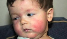 小孩吃角瓜过敏,警惕常见蔬菜背后的健康隐患