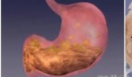 胃溃疡可以吃绿宝瓜吗,胃溃疡患者适宜食用绿宝瓜的饮食建议